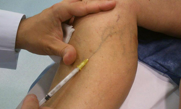 tipos-de-operacion-de-varices-900x550 https://www.varicesyulceras.com/wp-content/uploads/2024/07/tipos-de-operacion-de-varices-900x550-1.jpg