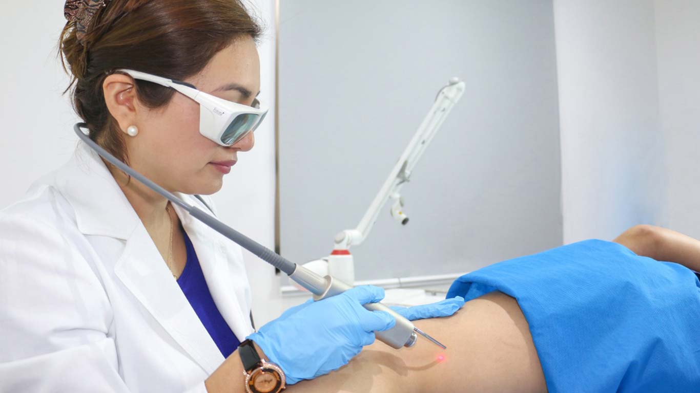 tratamientos de varices