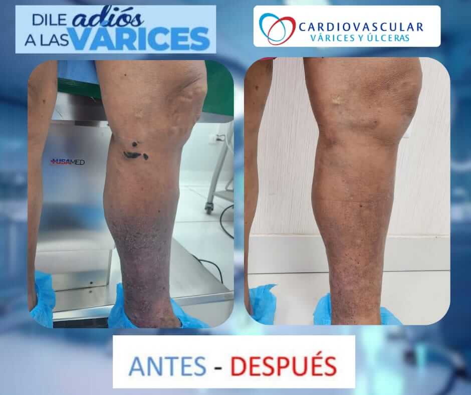 tratamiento de varices en lima -1