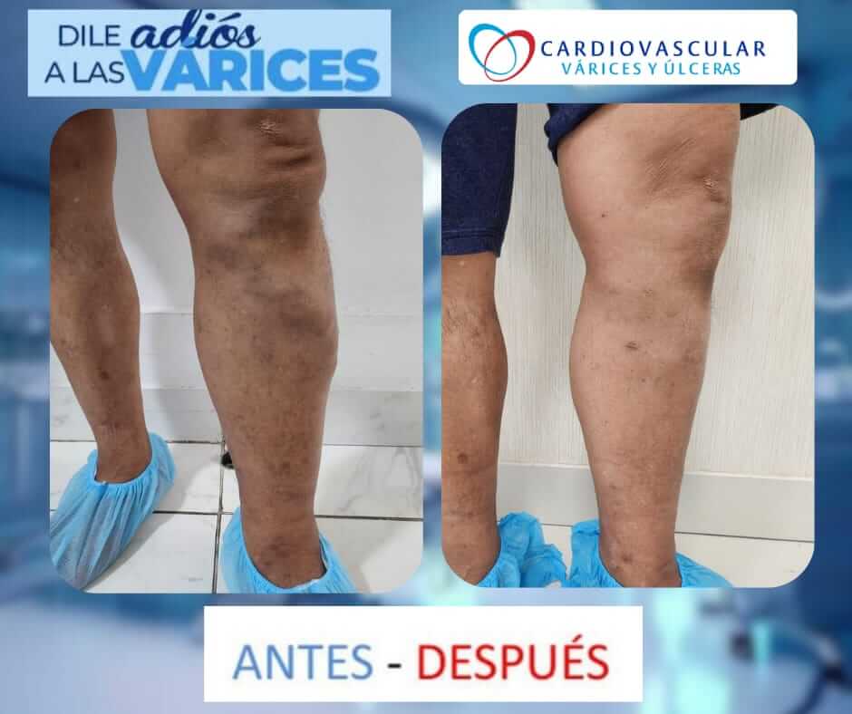 tratamiento de varices en lima -2