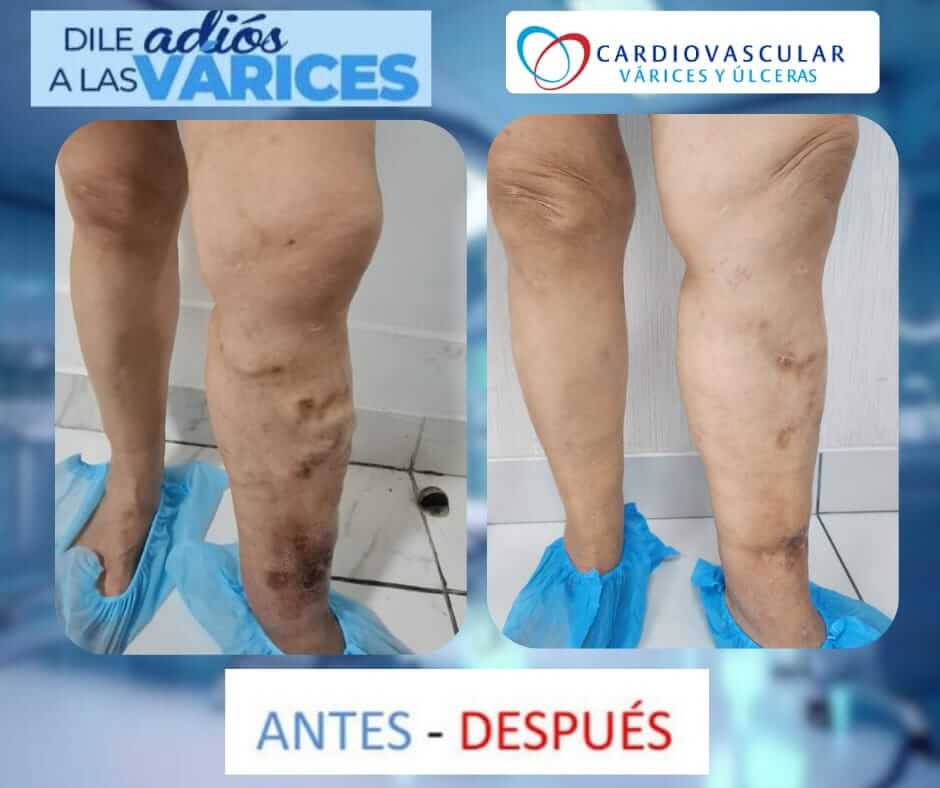 tratamiento de varices en lima -3