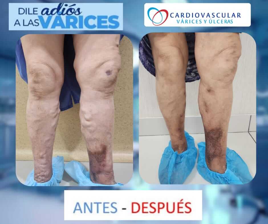 tratamiento de varices en lima -4