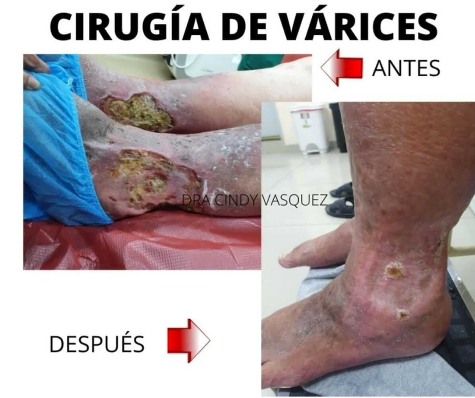 tratamiento de varices en lima